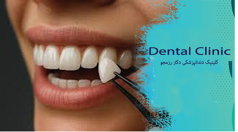 ماندگاری لمینت دندان
