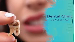 مراقبت‌های بعد از عصب‌کشی دندان