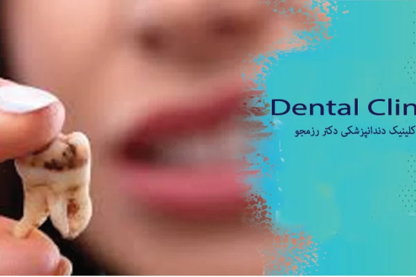 مراقبت‌های بعد از عصب‌کشی دندان