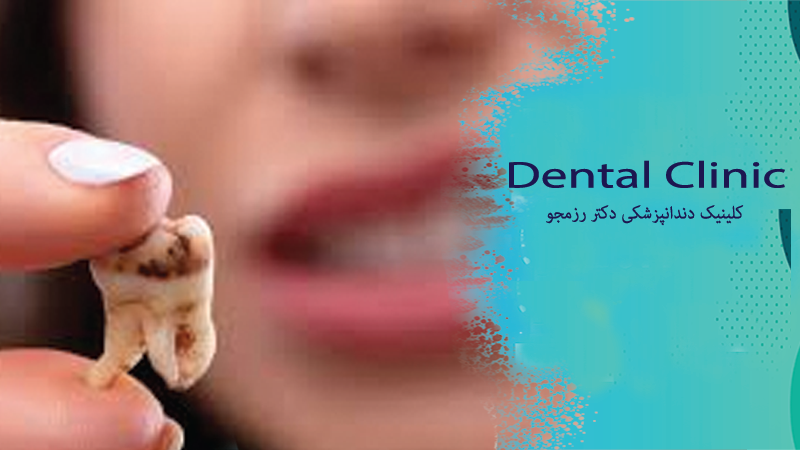 مراقبت‌های بعد از عصب‌کشی دندان