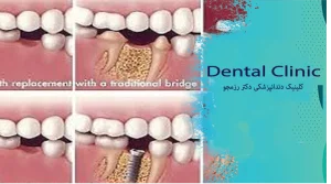 مقایسه ایمپلنت بریج و دندان مصنوعی