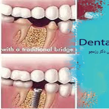 مقایسه ایمپلنت بریج و دندان مصنوعی