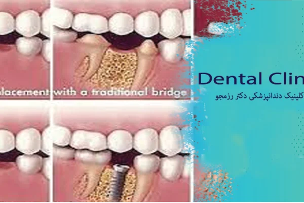 مقایسه ایمپلنت بریج و دندان مصنوعی