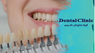 طول عمر لمینت دندان