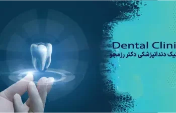 زمان ایمپلنت قدامی