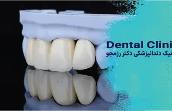 لمینت افراد بالای ۴۰ سال