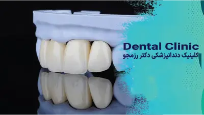 لمینت افراد بالای ۴۰ سال