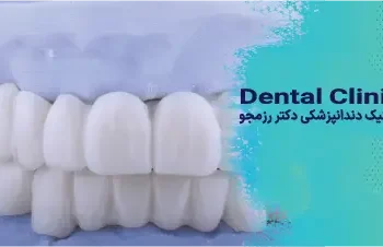 لمینت طبیعی یا هالیوودی
