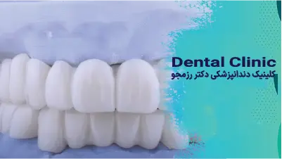لمینت طبیعی یا هالیوودی