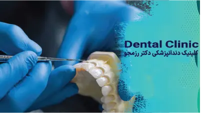 کامپوزیت بدون تراش دندان